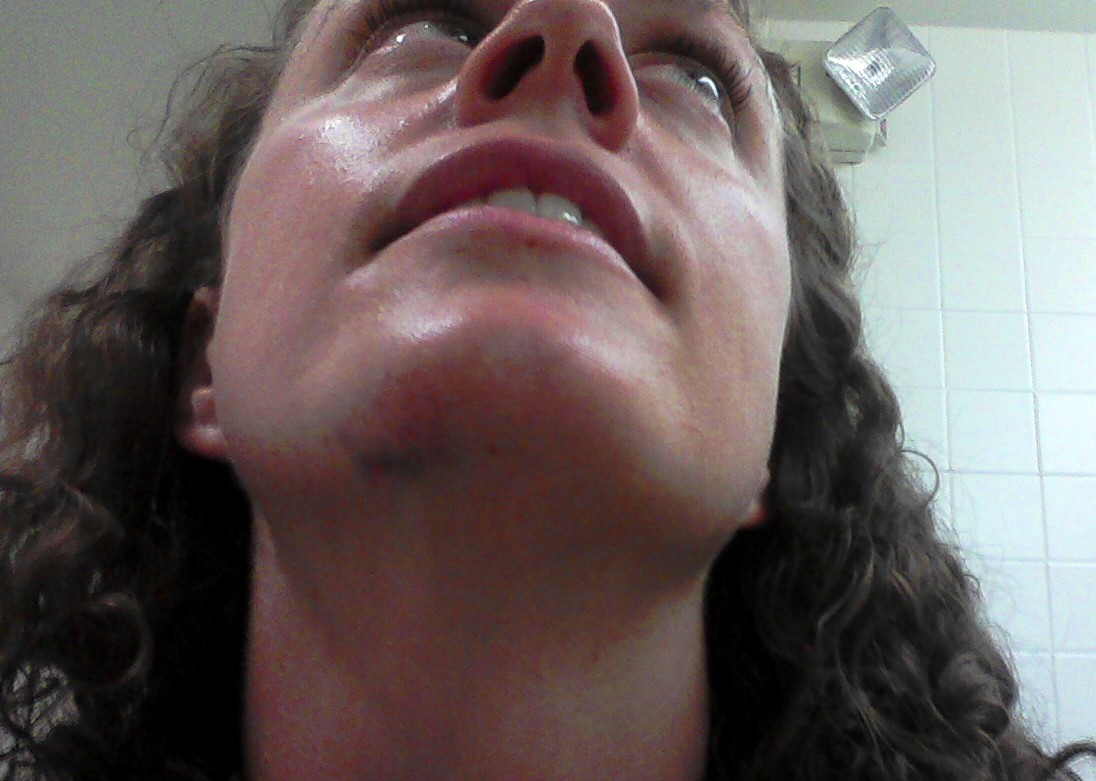 chin bruise