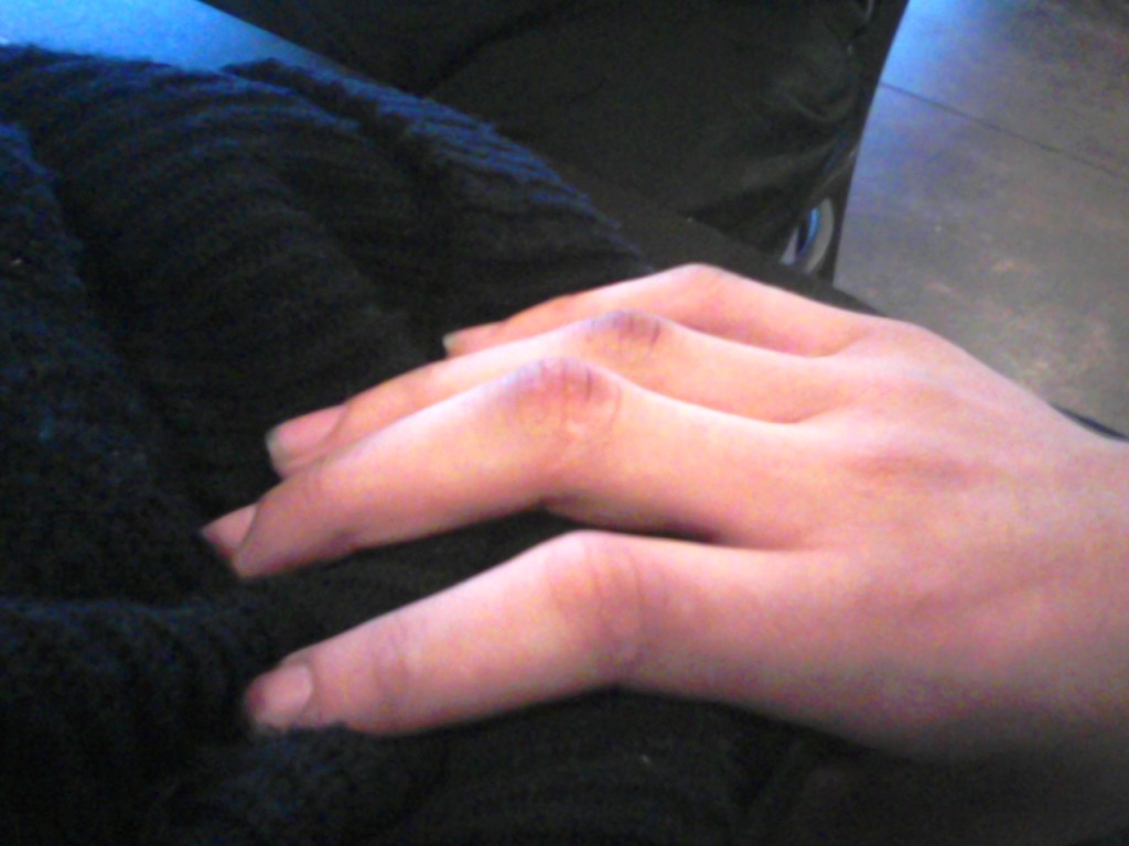 Jack's bruised knuckles